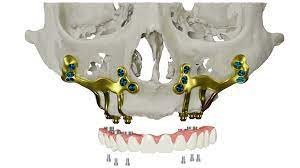 Customize Dental Implant